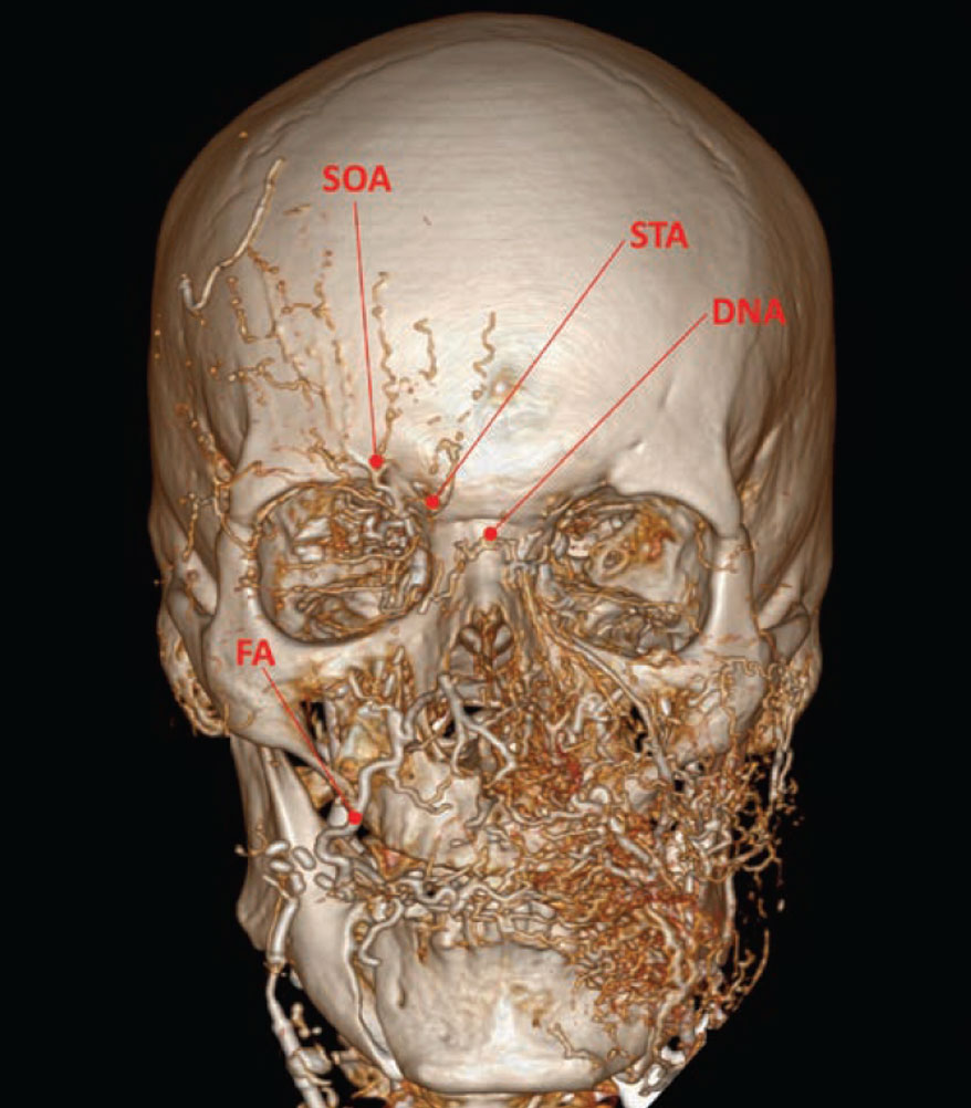 Three-dimensional reconstruction of a contrast-enhanced cranial computed tomographic scan.